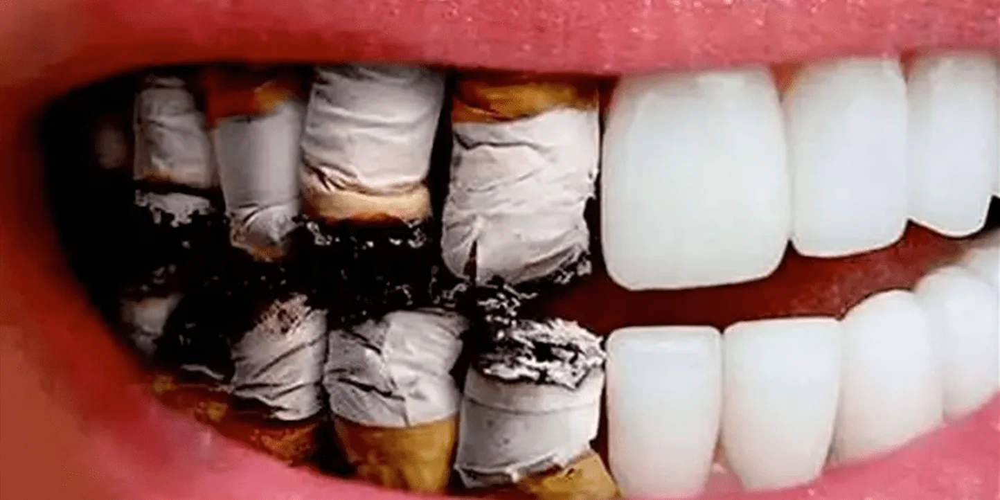 Montaje de los dientes de un fumador