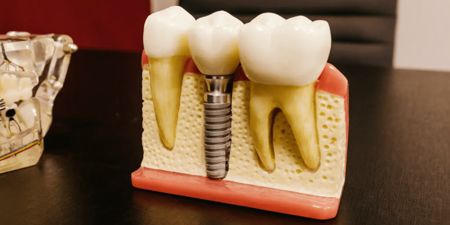Implante dental ejemplo