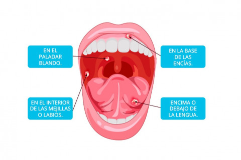 Partes de la boca donde se forman las aftas