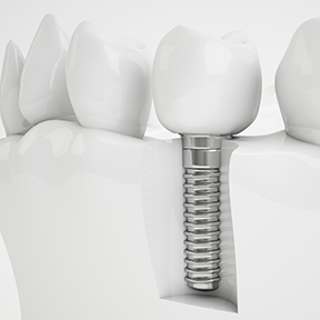 Implante diente