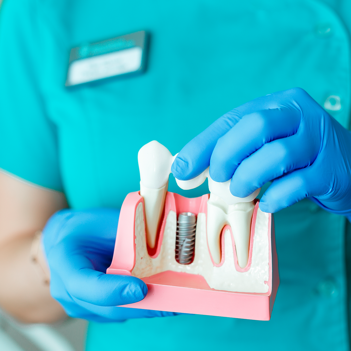 Recuperación de los implantes dentales