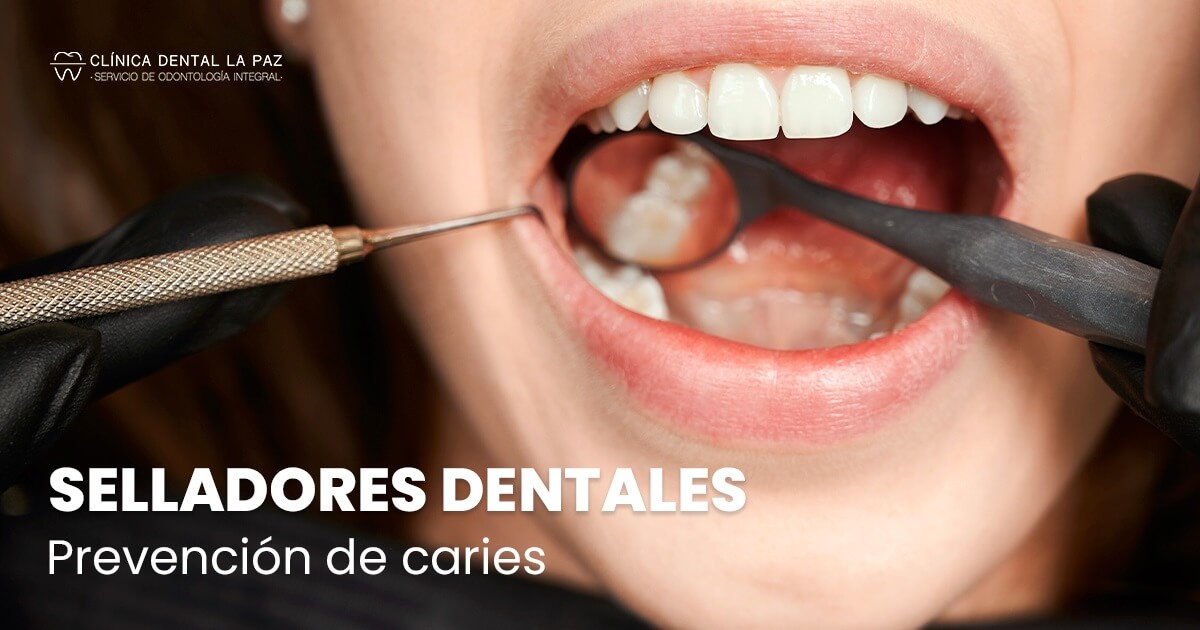 Selladores dentales para tu prevención dental