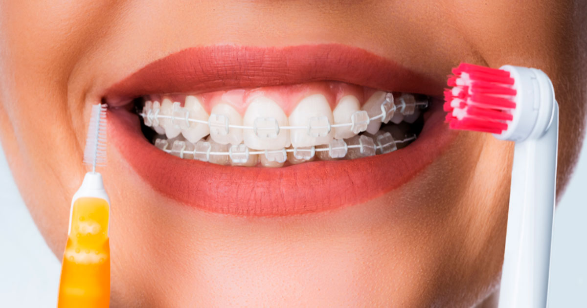 Consejos de limpieza dental brackets