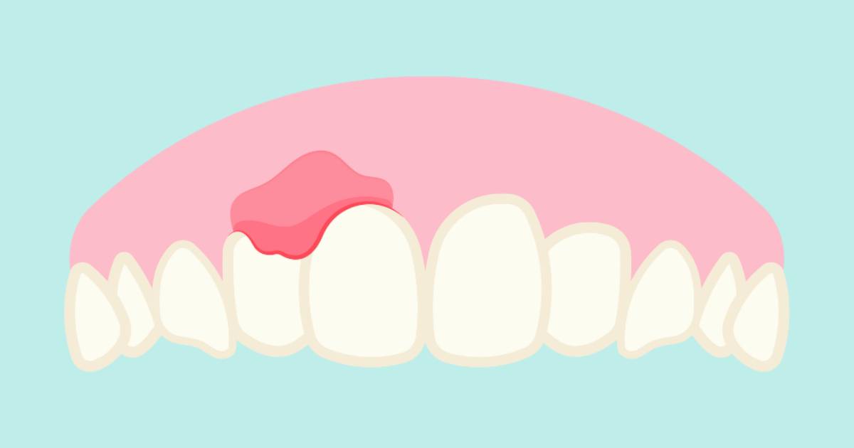 Absceso dental
