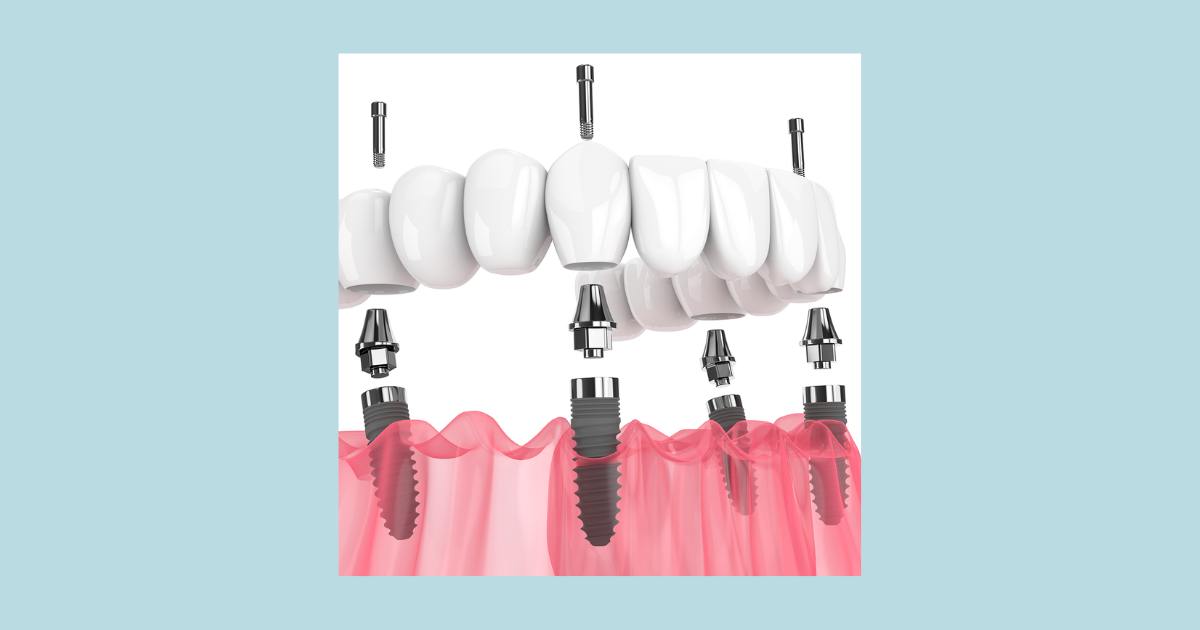 Implantes dentales All on four