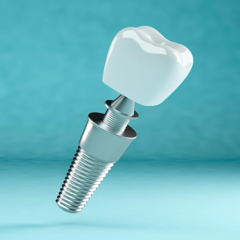 Implante dental en Málaga