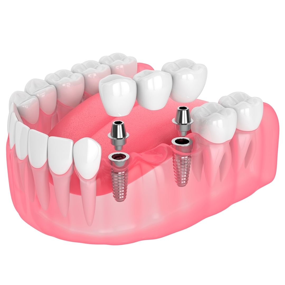 Prótesis dentales Prótesis dentales