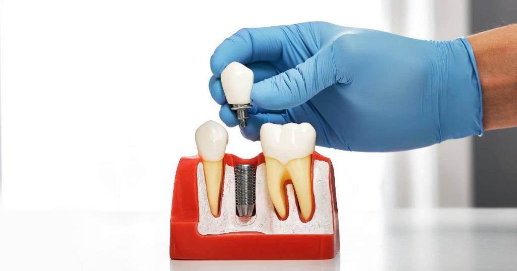 Rechazo implante dental