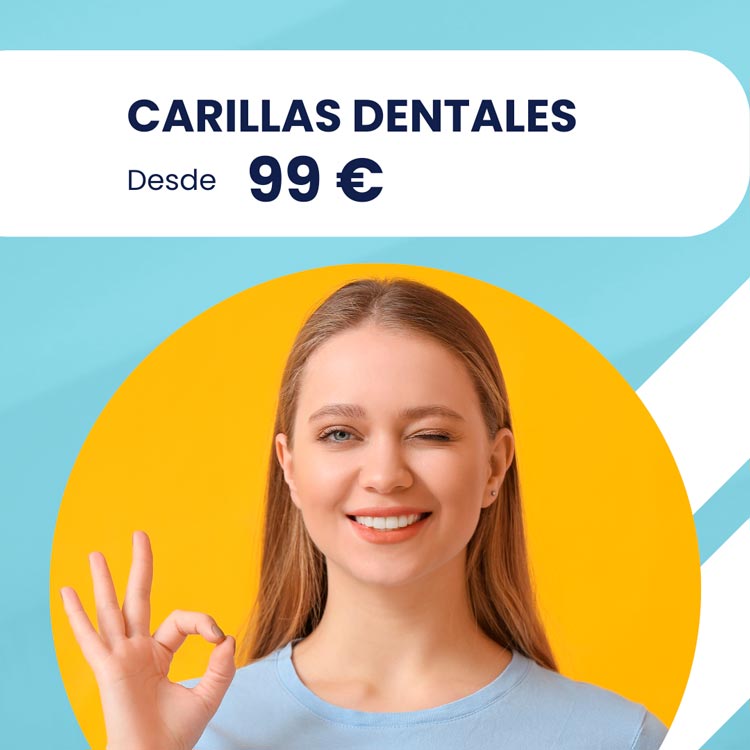 Carillas dentales en Málaga