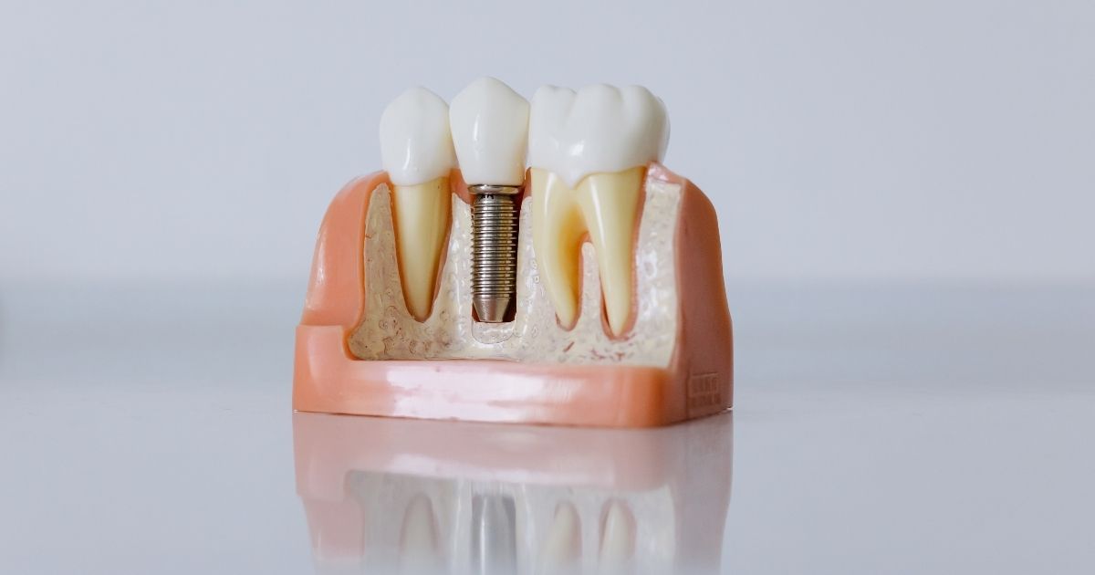 porque se aflojan las coronas de los implantes