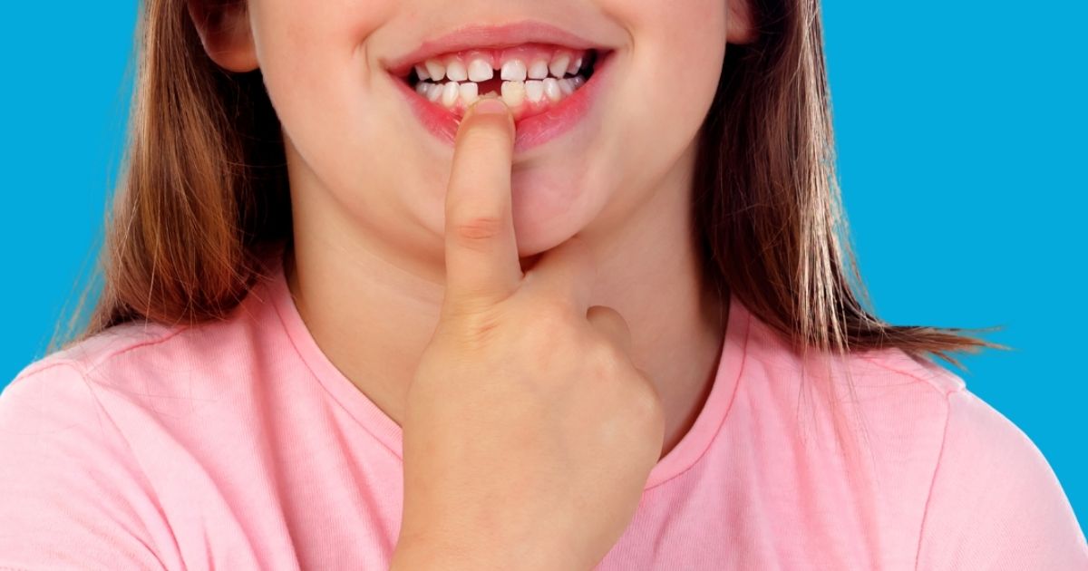 agenesia dental