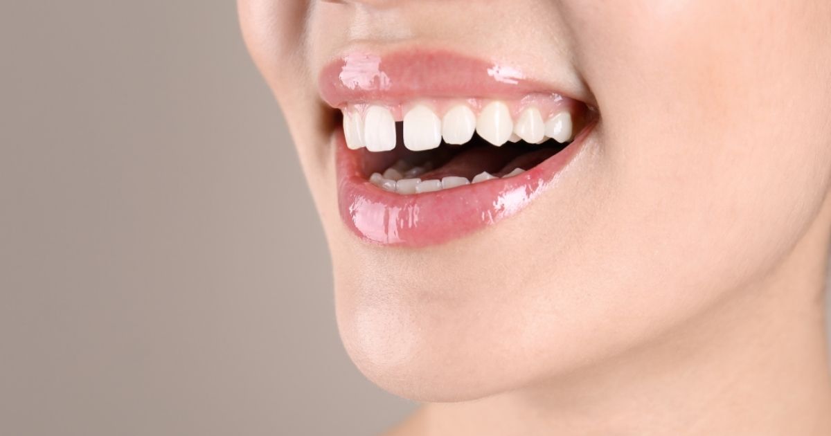 diastema