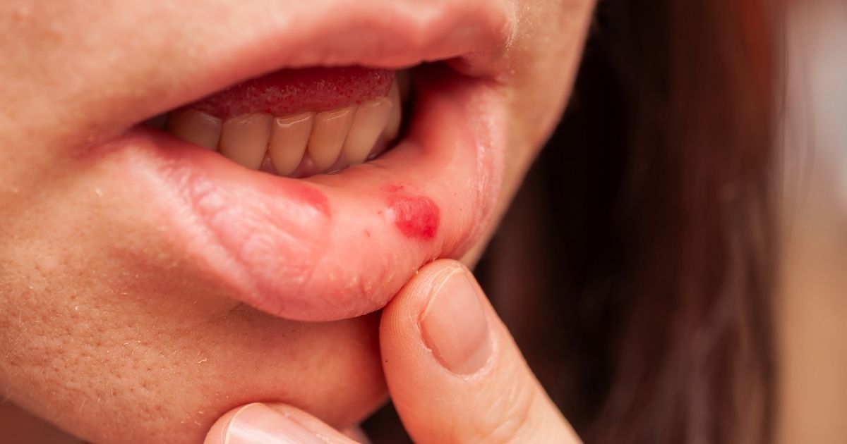 porque sale el herpes labial