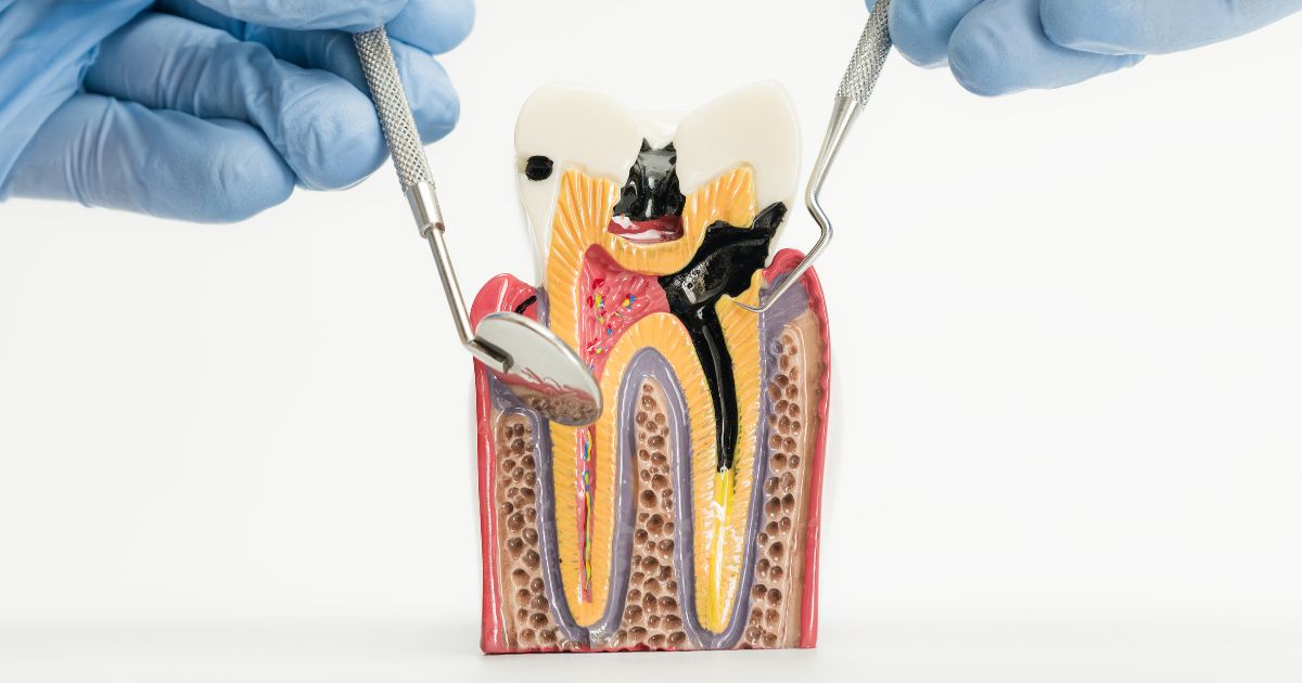 ligamento periodontal inflamado