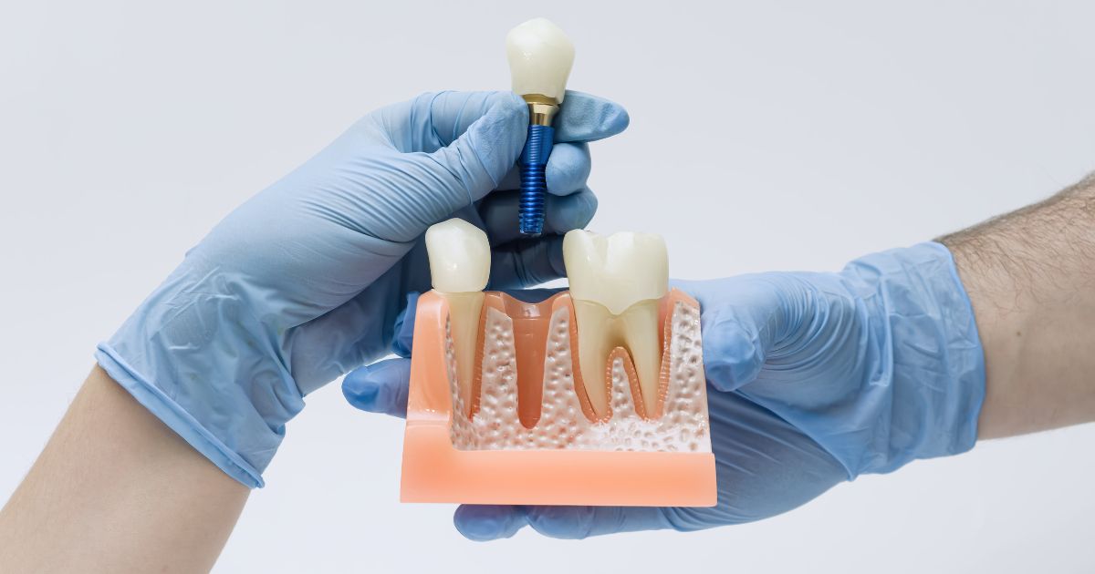 infeccion implante dental sintomas