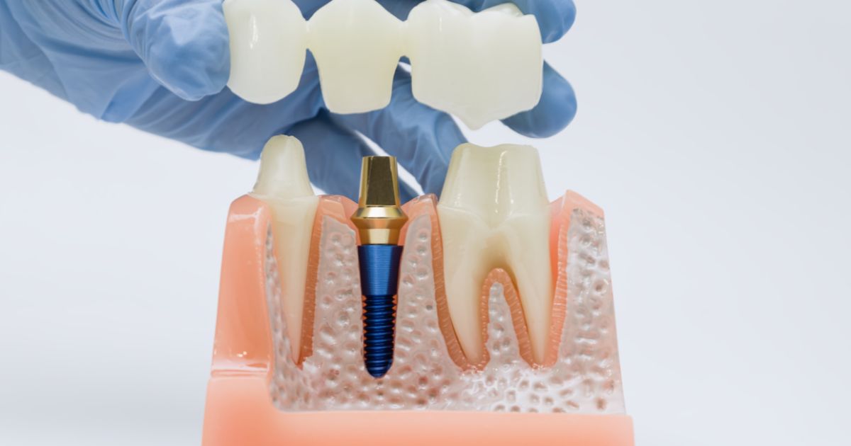 cuanto se tarda en poner una corona dental