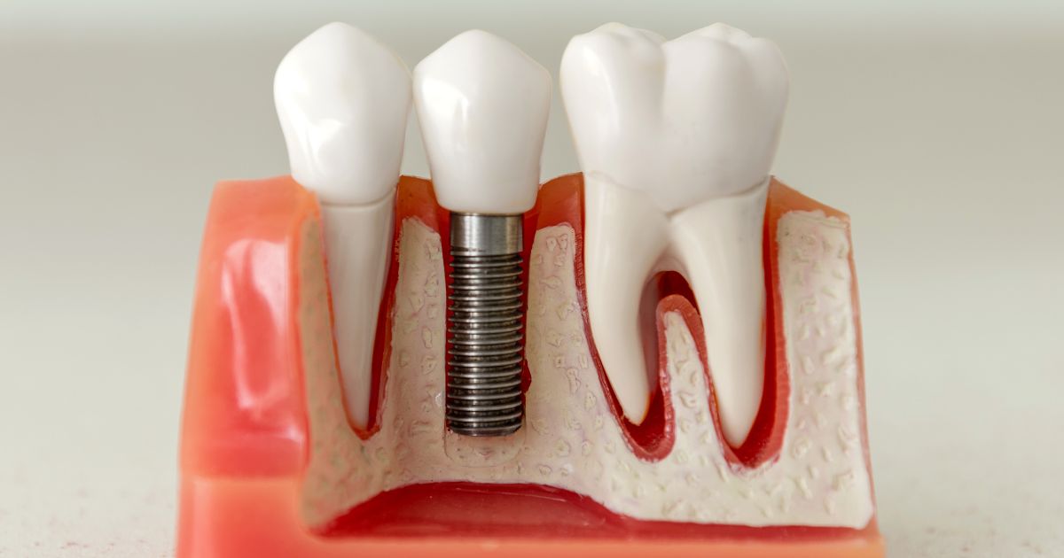 implantes boca completa