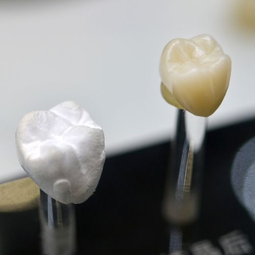 corona dental Clínica Dental La Paz