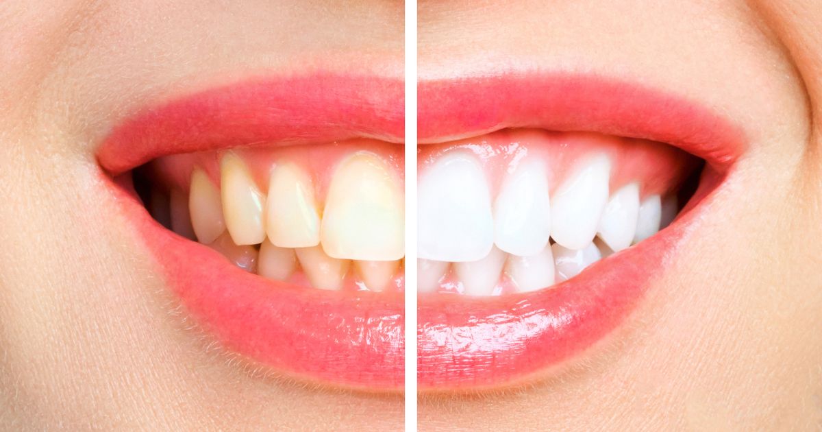 dientes amarillos
