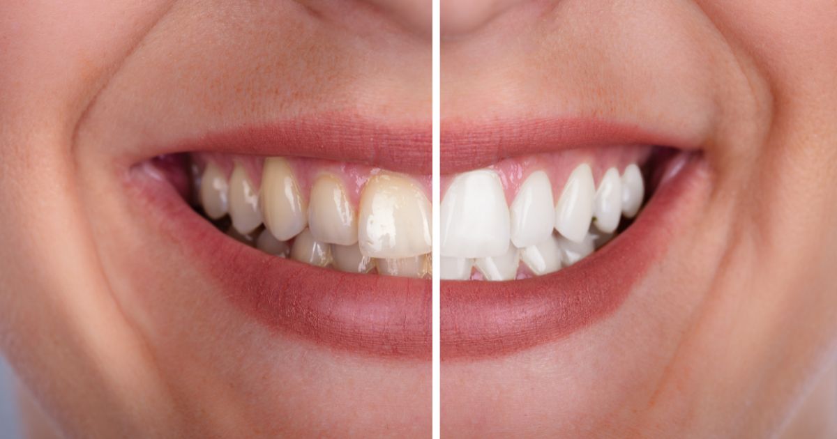 dientes amarillos