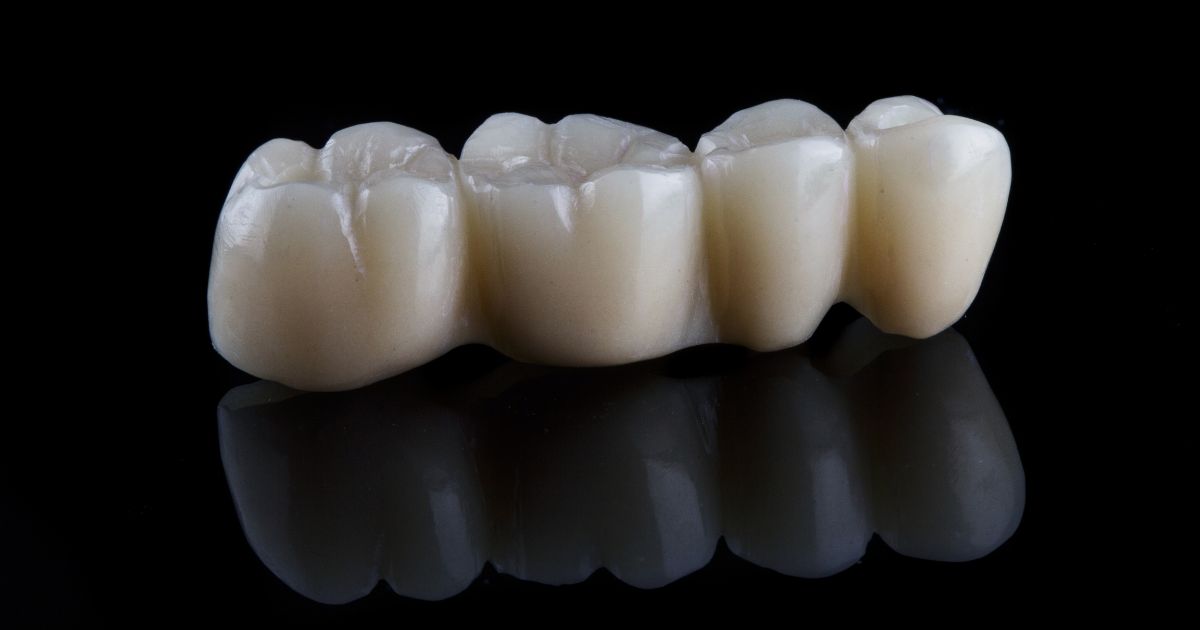 puente dental