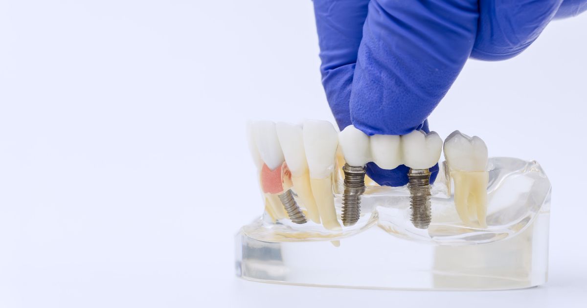 protesis fija sobre implantes