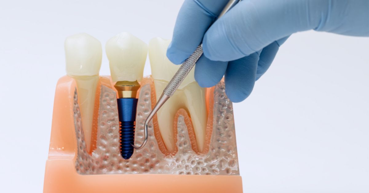 Cómo favorecer la osteointegración de un implante